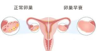 卵巢早衰POF