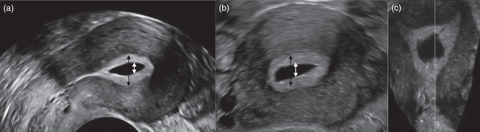 宫腔积液 试管移植