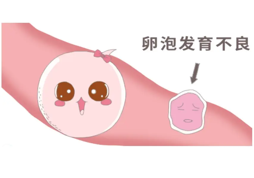 卵泡发育不良的原因及治疗